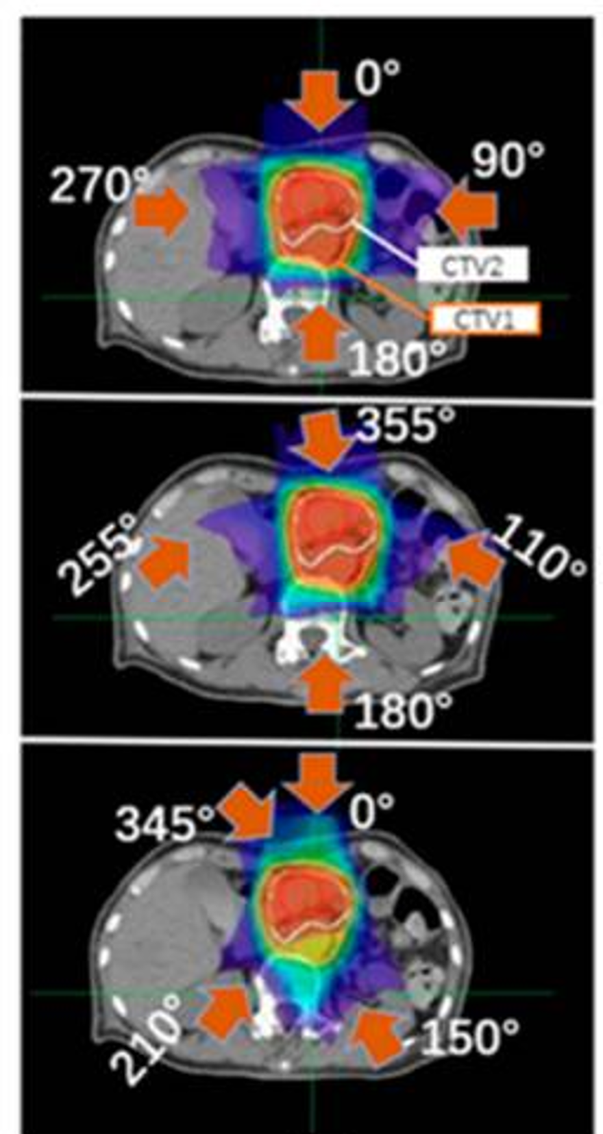 粒子線治療の線量分布イメージ
